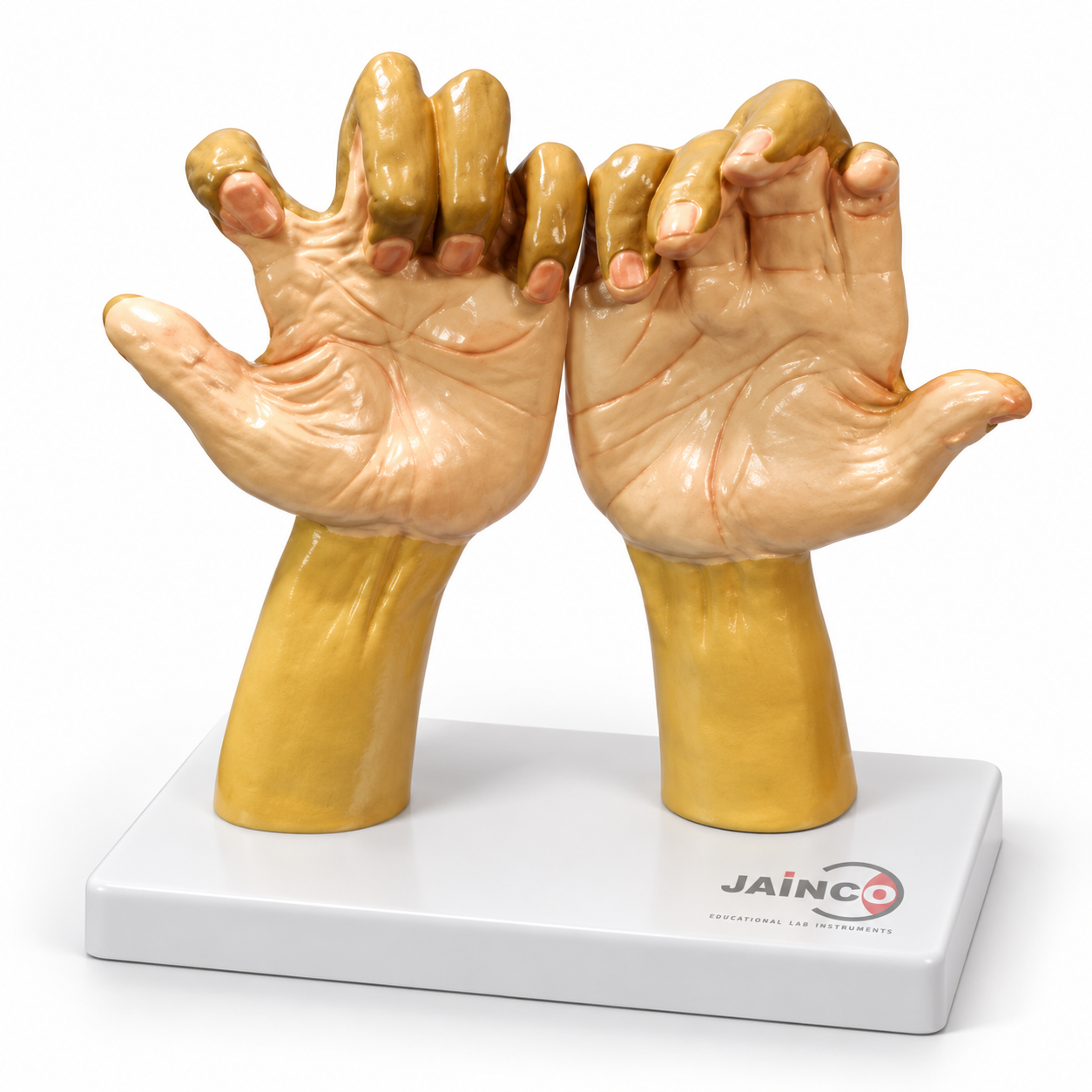 Claw Hands in Leprosy Model